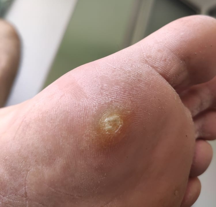 Heloma o clavos