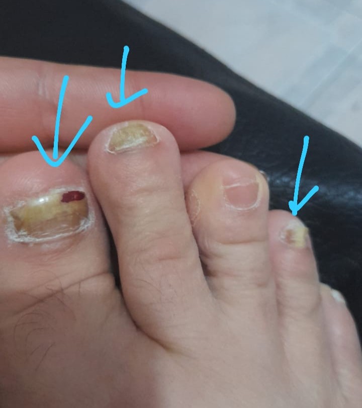 Hongos en las uñas